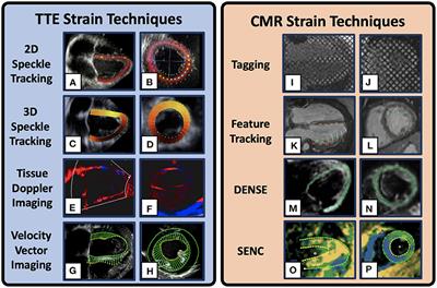 Myocardial strain imaging in Duchenne muscular dystrophy
